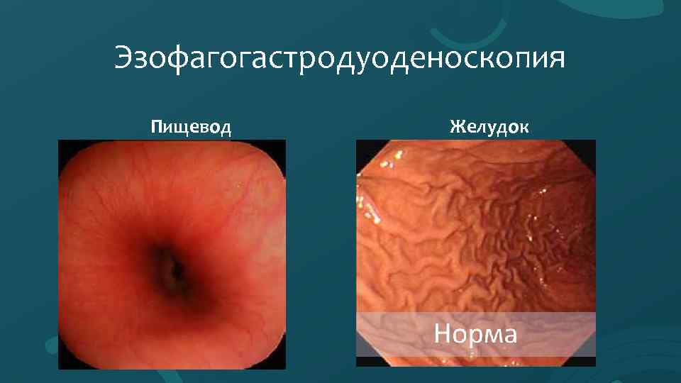 Эзофагогастродуоденоскопия Пищевод Желудок 