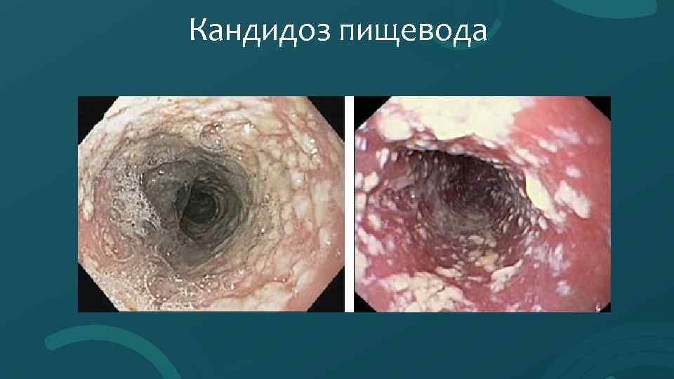 Кандидоз пищевода 