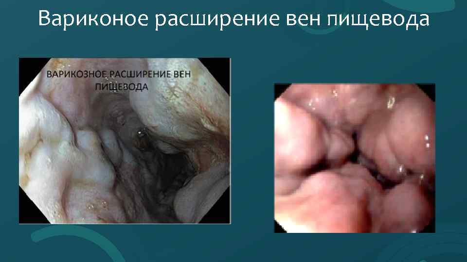 Вариконое расширение вен пищевода 