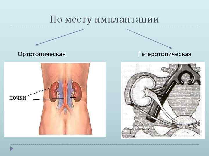 По месту имплантации Ортотопическая Гетеротопическая 