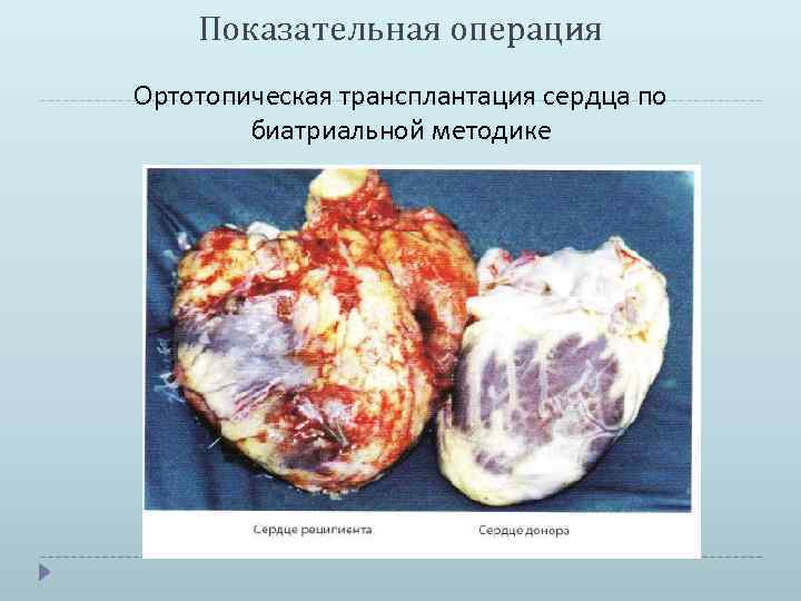 Показательная операция Ортотопическая трансплантация сердца по биатриальной методике 