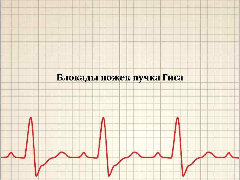 Блокады ножек пучка Гиса 