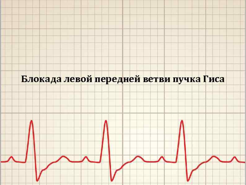 Блокада левой передней ветви пучка Гиса 