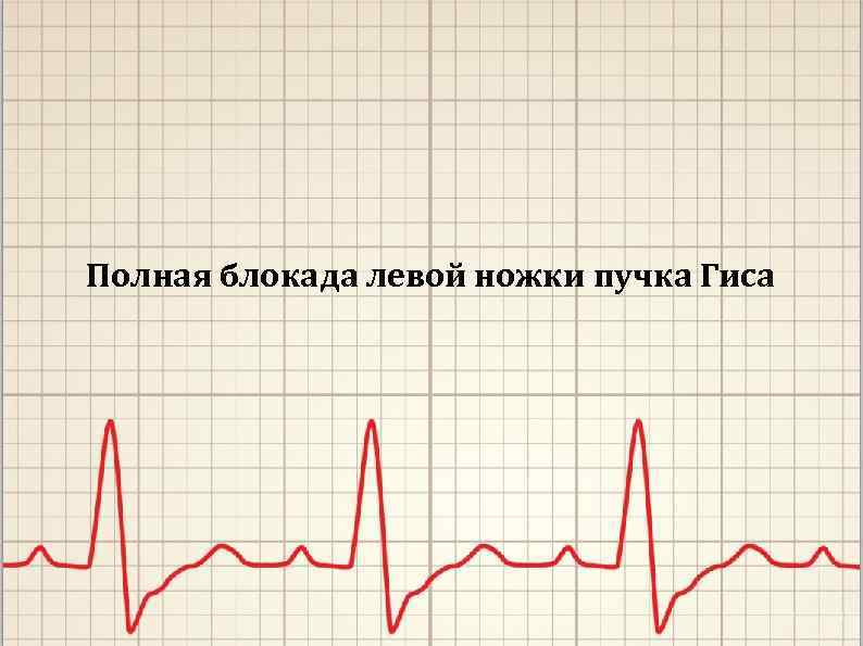 Полная блокада левой ножки пучка Гиса 