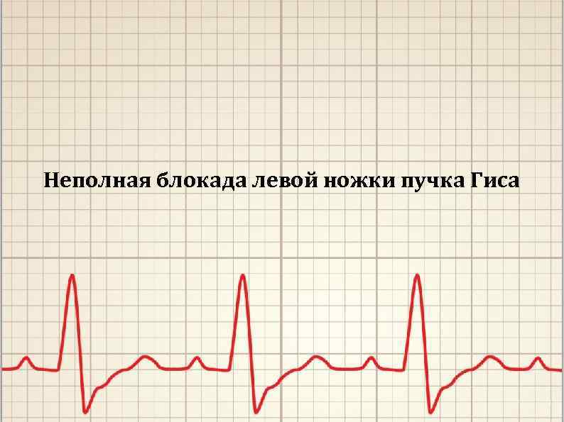 Неполная блокада левой ножки пучка Гиса 