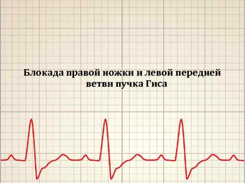 Блокада правой ножки и левой передней ветви пучка Гиса 