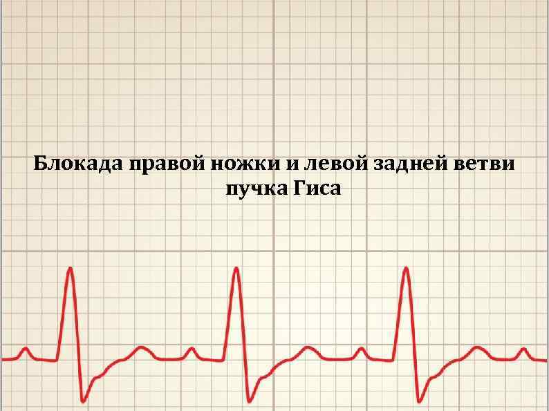Блокада правой ножки и левой задней ветви пучка Гиса 