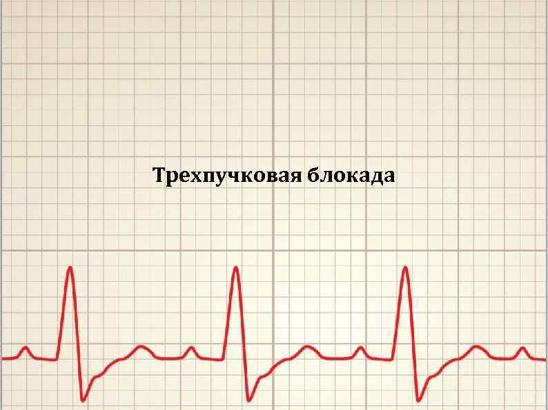 Трехпучковая блокада 