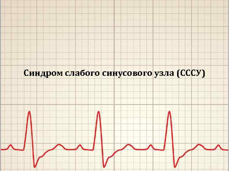 Синдром слабого синусового узла (СССУ) 