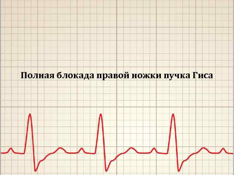 Полная блокада правой ножки пучка Гиса 