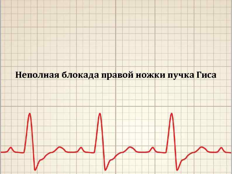 Неполная блокада правой ножки пучка Гиса 