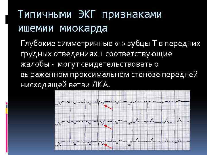 Типичными ЭКГ признаками ишемии миокарда Глубокие симметричные «-» зубцы Т в передних грудных отведениях