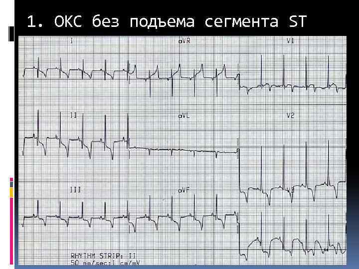 1. ОКС без подъема сегмента ST 