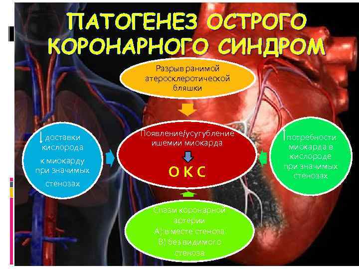 ПАТОГЕНЕЗ ОСТРОГО КОРОНАРНОГО СИНДРОМ Разрыв ранимой атеросклеротической бляшки доставки кислорода Появление/усугубление ишемии миокарда к
