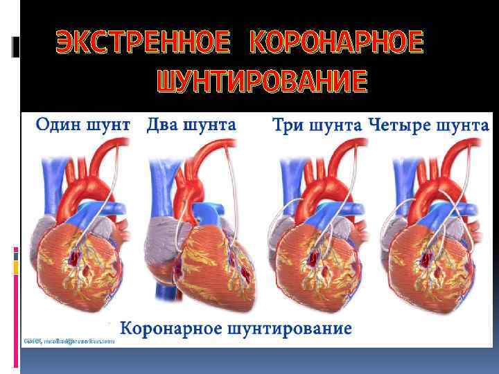 ЭКСТРЕННОЕ КОРОНАРНОЕ ШУНТИРОВАНИЕ 