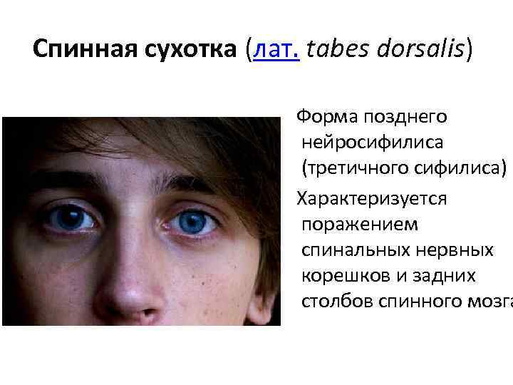 Спинная сухотка (лат. tabes dorsalis) Форма позднего нейросифилиса (третичного сифилиса) Характеризуется поражением спинальных нервных