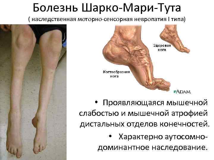Болезнь Шарко-Мари-Тута ( наследственная моторно-сенсорная невропатия I типа) • Проявляющаяся мышечной слабостью и мышечной