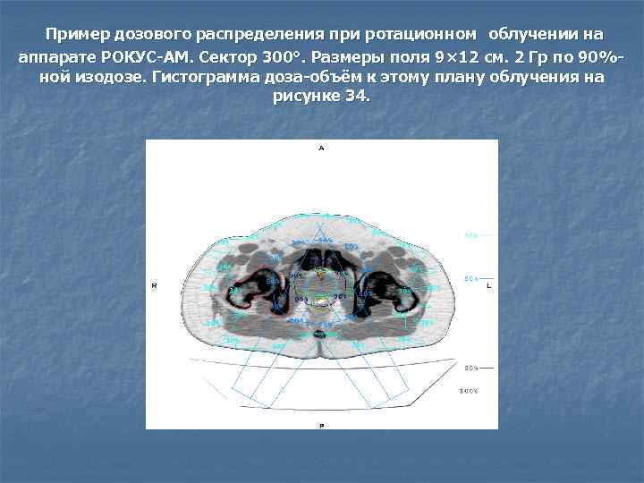  Пример дозового распределения при ротационном облучении на аппарате РОКУС-АМ. Сектор 300°. Размеры поля