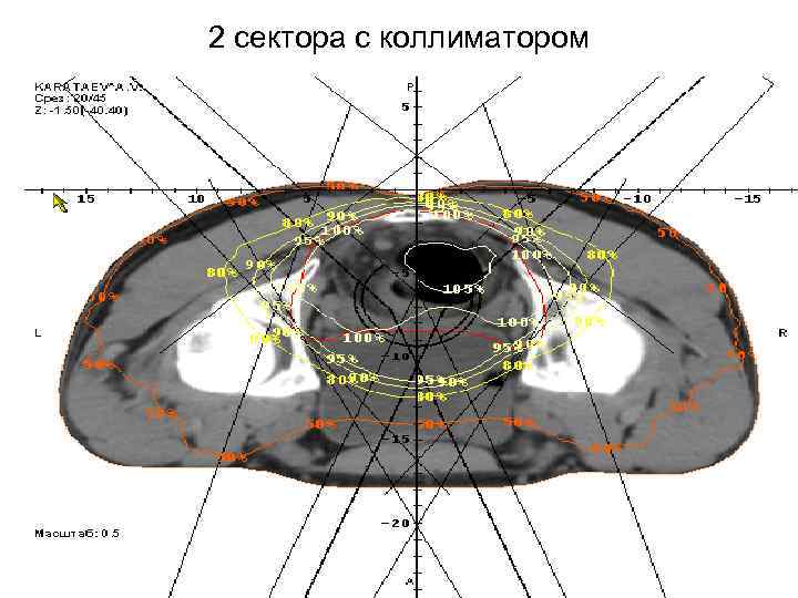 2 сектора с коллиматором 
