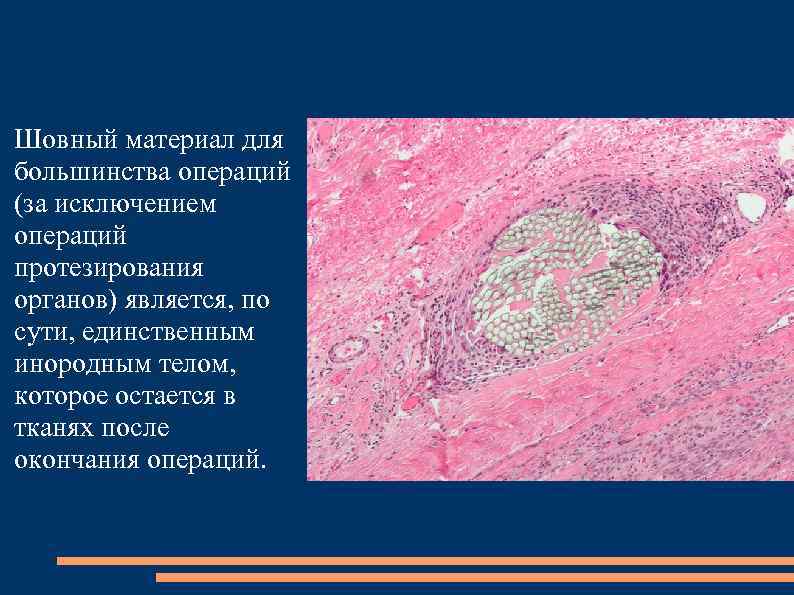 Шовный материал для большинства операций (за исключением операций протезирования органов) является, по сути, единственным