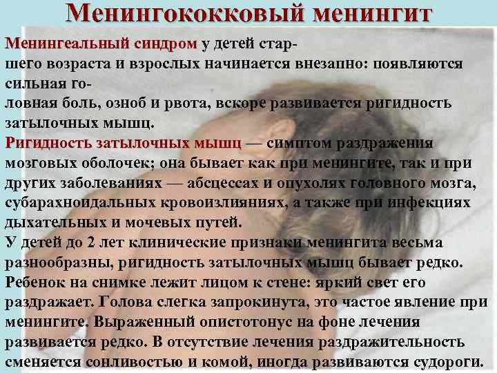 Менингококковый менингит Менингеальный синдром у детей стар синдром шего возраста и взрослых начинается внезапно: