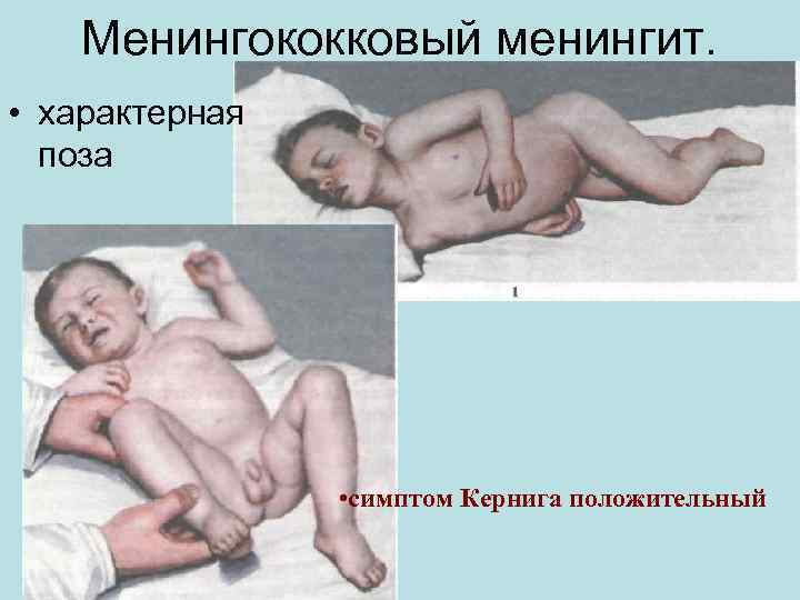 Менингококковый менингит. • характерная поза • симптом Кернига положительный 