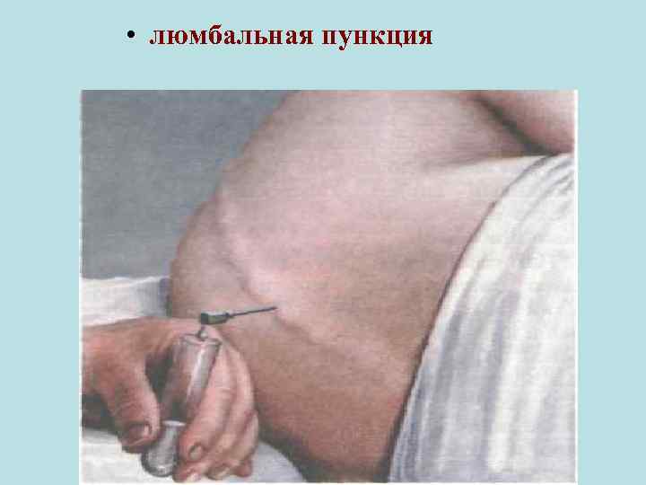  • люмбальная пункция 