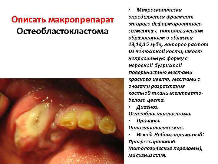 Описать макропрепарат Остеобластокластома • Макроскопически определяется фрагмент второго деформированного сегмента с патологическим образованием в