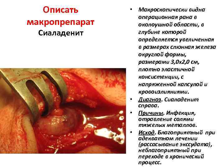 Описать макропрепарат Сиаладенит • Макроскопически видна операционная рана в околоушной области, в глубине которой