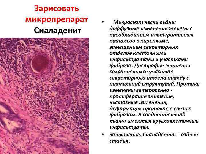 Зарисовать микропрепарат Сиаладенит Микроскопически видны диффузные изменения железы с преобладанием альтеративных процессов в паренхиме,