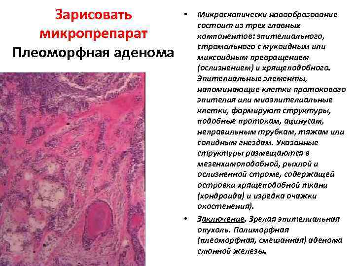 Зарисовать микропрепарат Плеоморфная аденома • • Микроскопически новообразование состоит из трех главных компонентов: эпителиального,