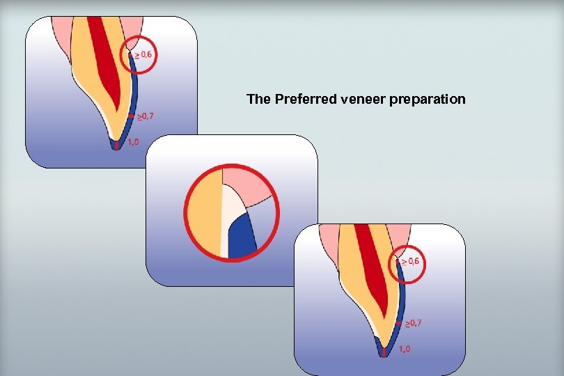 IPS 19 d. SIGN® The Preferred veneer preparation The success story Shade selection /