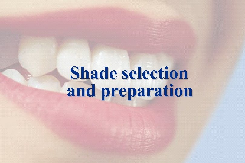 25 Shade selection and preparation The success story Shade selection / IPS Empress Esthetic