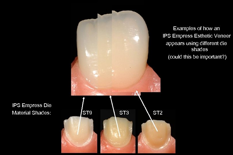 30 Examples of how an IPS Empress Esthetic Veneer appears using different die shades