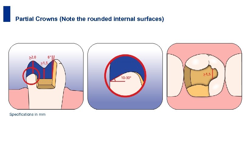 32 Partial Crowns (Note the rounded internal surfaces) Specifications in mm The success story