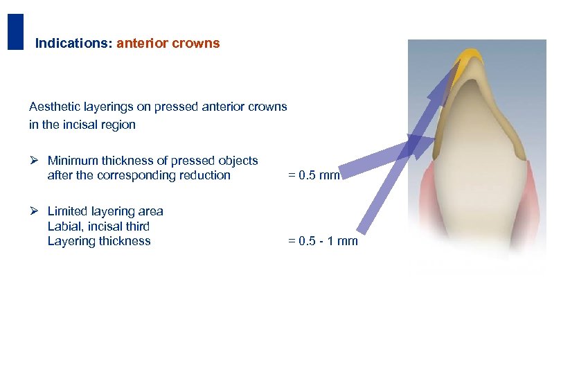 35 Indications: anterior crowns Aesthetic layerings on pressed anterior crowns in the incisal region