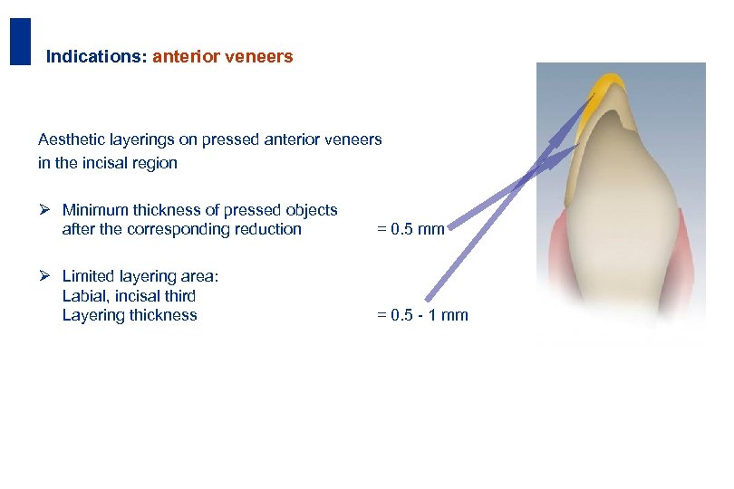 36 Indications: anterior veneers Aesthetic layerings on pressed anterior veneers in the incisal region