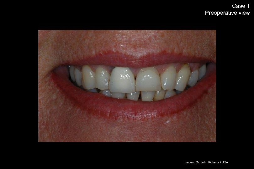 54 Case 1 Preoperative view The success story Shade selection / IPS Empress Esthetic