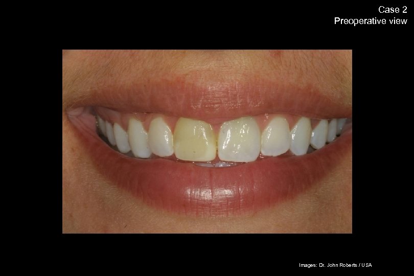 56 Case 2 Preoperative view The success story Shade selection / IPS Empress Esthetic