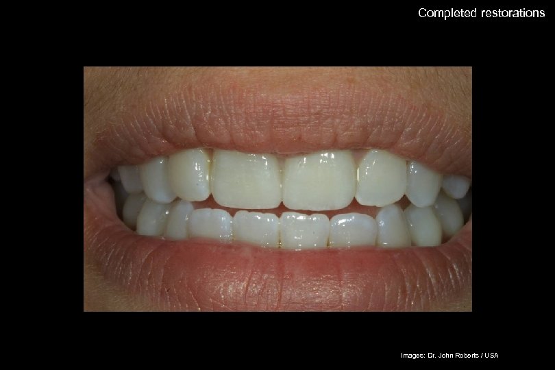 57 Completed restorations The success story Shade selection / IPS Empress Esthetic Adhesive preparation