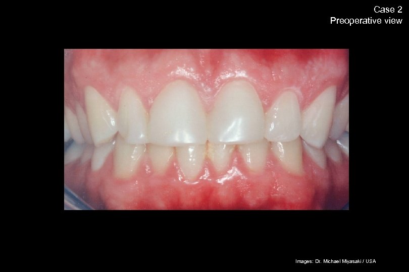 60 Case 2 Preoperative view The success story Shade selection / IPS Empress Esthetic