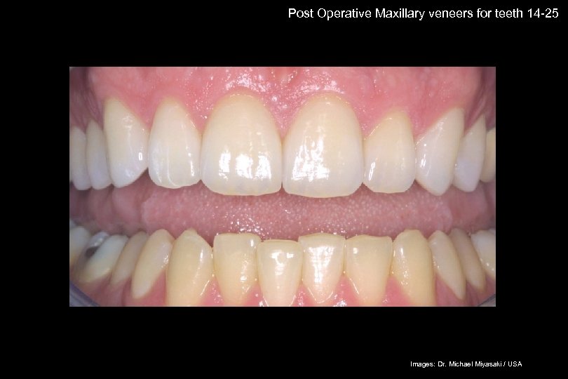 61 Post Operative Maxillary veneers for teeth 14 -25 The success story Shade selection