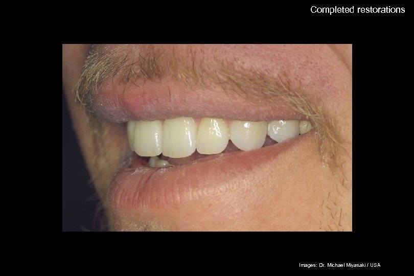 62 Completed restorations The success story Shade selection / IPS Empress Esthetic Adhesive preparation