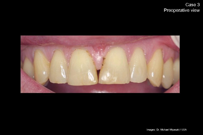 63 Case 3 Preoperative view The success story Shade selection / IPS Empress Esthetic