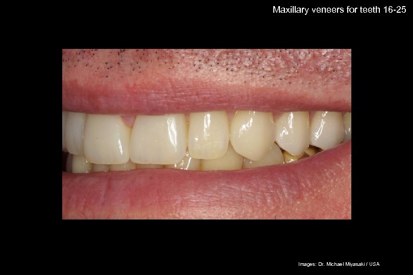 64 Maxillary veneers for teeth 16 -25 The success story Shade selection / IPS