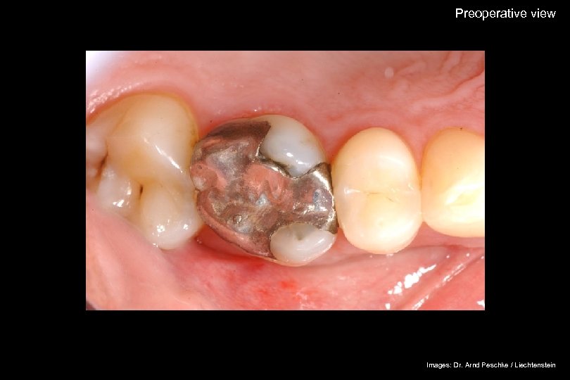 Preoperative view The success story Shade selection / IPS Empress Esthetic Adhesive preparation Adhesive