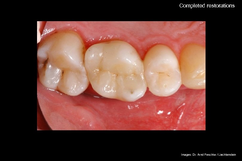 Completed restorations The success story Shade selection / IPS Empress Esthetic Adhesive preparation Adhesive