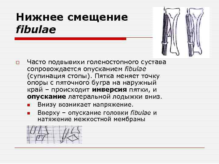Нижнее смещение fibulae o Часто подвывихи голеностопного сустава сопровождается опусканием fibulae (супинация стопы). Пятка