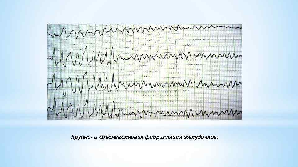 Крупно- и средневолновая фибрилляция желудочков. 