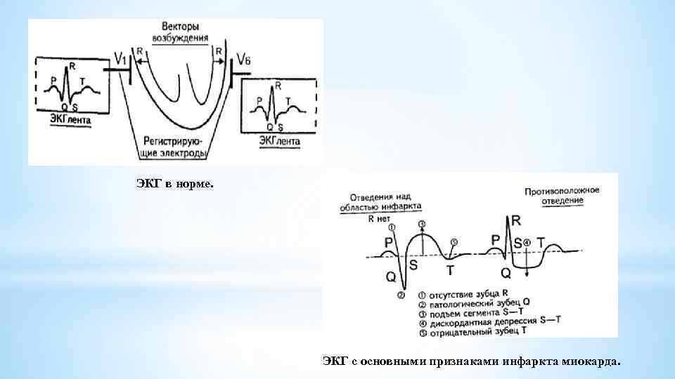 ЭКГ в норме. ЭКГ с основными признаками инфаркта миокарда. 